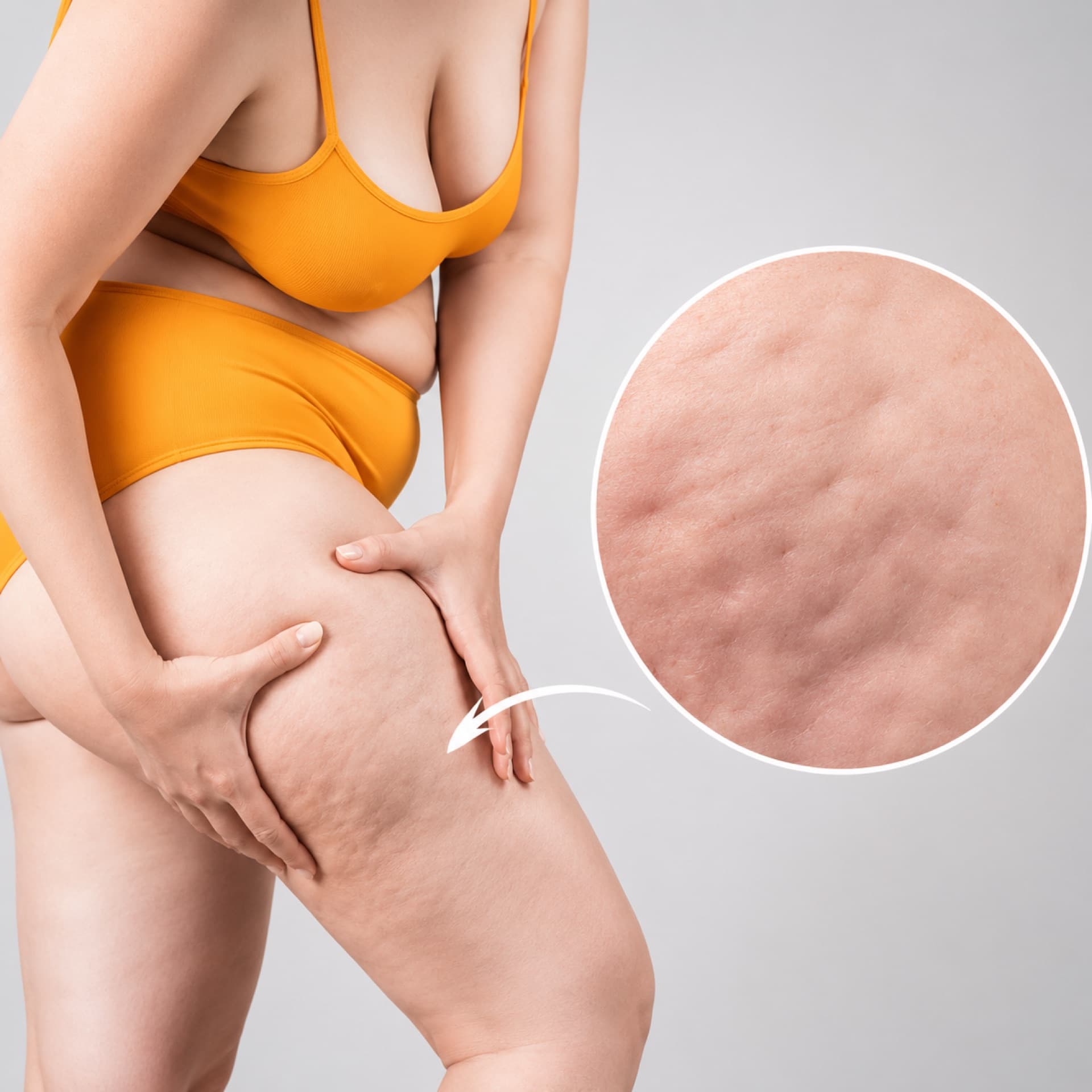 Lipedema